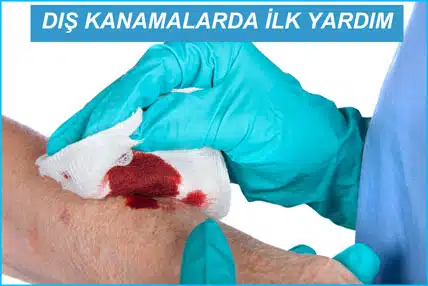 Dış kanamalarda ilk yardım nasıl yapılır