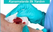Kanamalarda İlk Yardım
