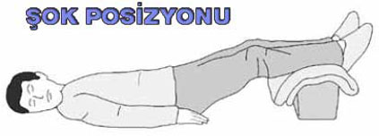 Şok pozisyonu nasıl verilir.