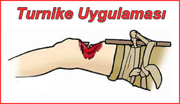 Hangi durumlarda turnike uygulanmalıdır? 2 Turnike uygulaması