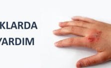 Yanığa Ne İyi Gelir?