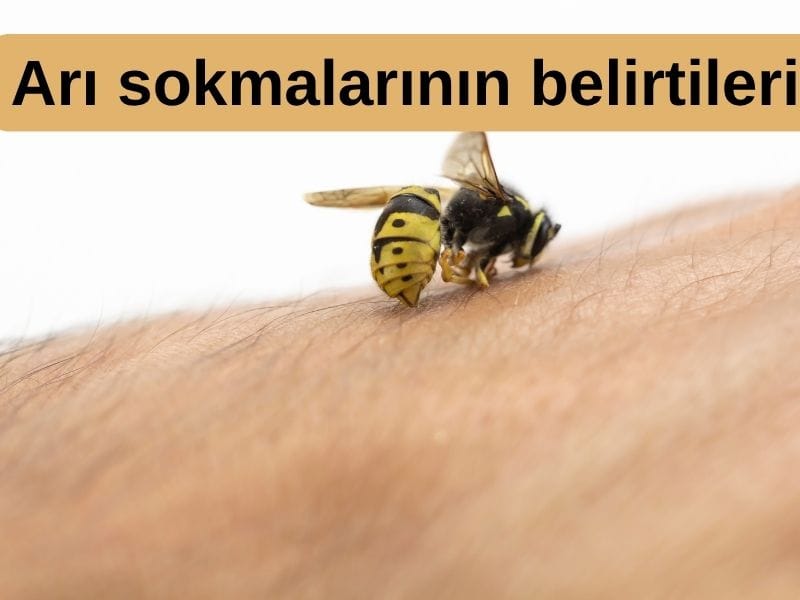 Arı sokmalarının belirtileri