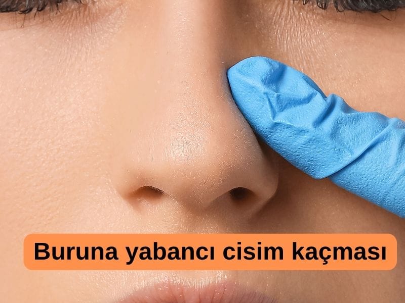 Buruna yabancı cisim kaçmasında ilkyardım nasıl olmalıdır?