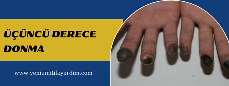 Üçüncü derece donma