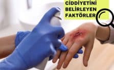 Yanığın ciddiyetini belirleyen faktörler nelerdir?