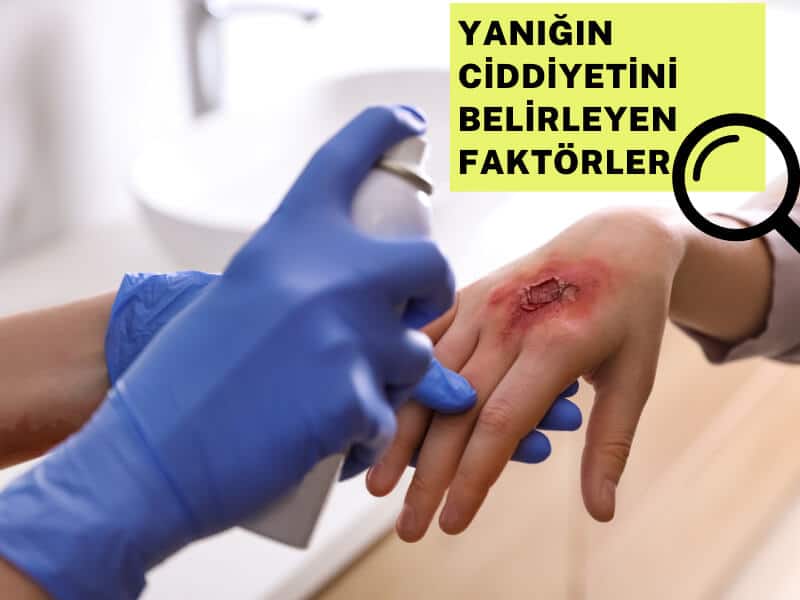 Yanığın ciddiyetini belirleyen faktörler