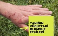 Yanığın vücuttaki olumsuz etkileri nelerdir?