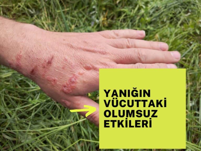 Yanığın olumsuz etkileri