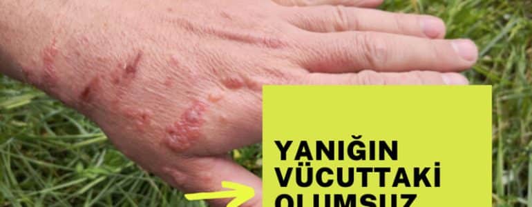 Yanığın olumsuz etkileri