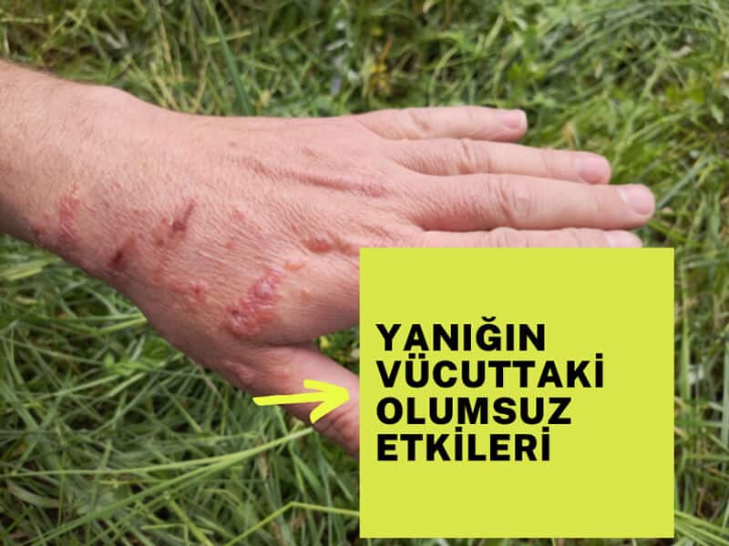 Yanığın olumsuz etkileri