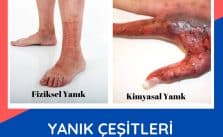 Yanık Çeşitleri