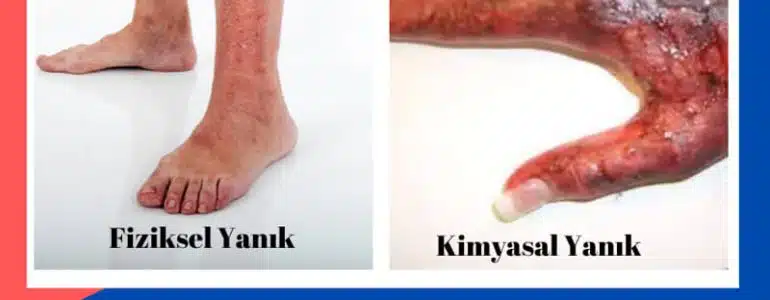 Yanık Çeşitleri