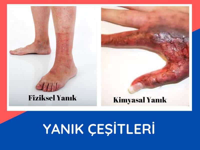 Yanık Çeşitleri