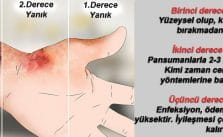 Yanıklar nasıl derecelendirilir?