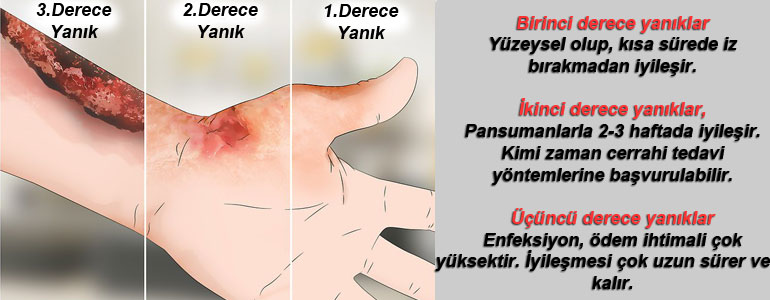 Yanık Türleri